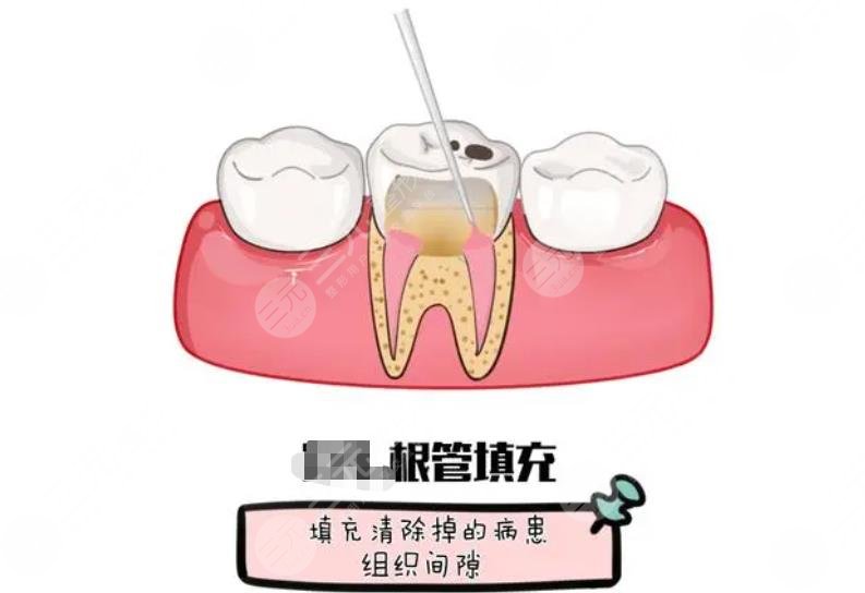 根管緩解一顆牙多少?錢?