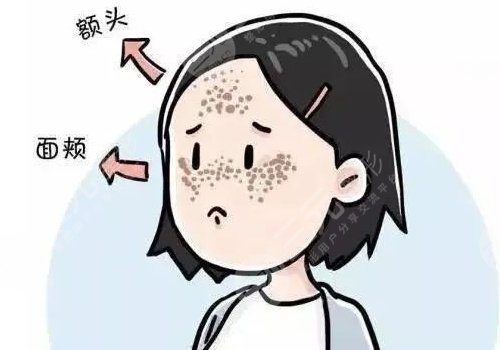 怎樣祛斑果好些?