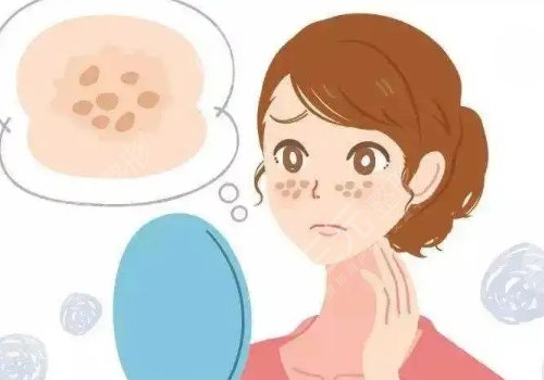 怎樣祛斑果好些?