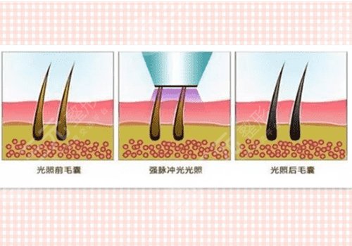 光子脫毛需要幾次能脫干凈?