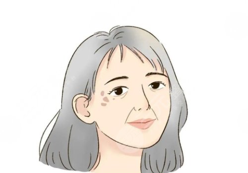 怎樣治老年斑？