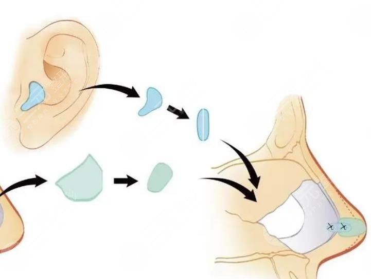 自體軟骨隆鼻多少錢?