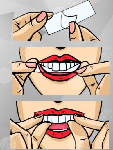 牙貼對(duì)牙齒有傷害嗎?