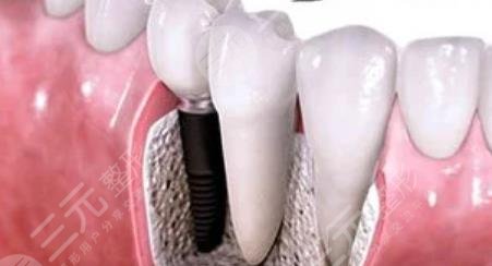 牙齒種植