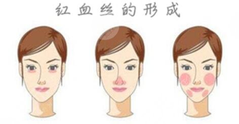 臉上為什么會出現(xiàn)紅血絲?