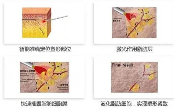 等離子激光溶脂三大功能有哪些?