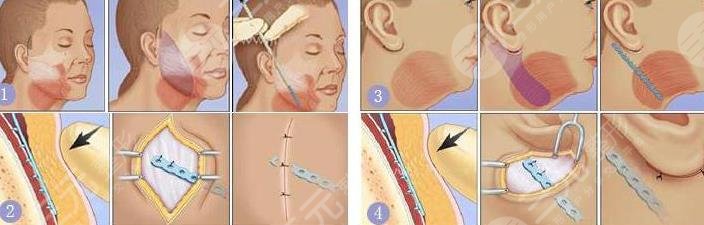 大拉皮除皺手術后可維持多少年