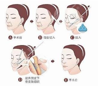 大拉皮除皺手術后可維持多少年