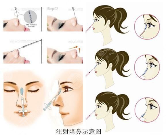 玻尿酸隆鼻可以維持多久?