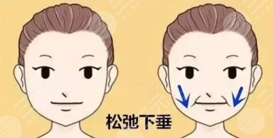 面部下垂提升術(shù)多少錢？具體術(shù)式、操作方案及步驟、預(yù)期果點(diǎn)擊了解！
