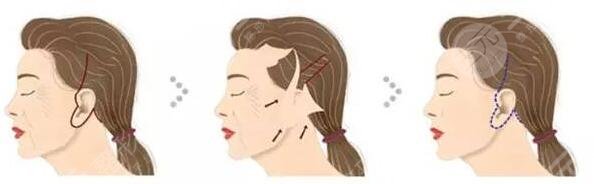 面部下垂提升術(shù)多少錢