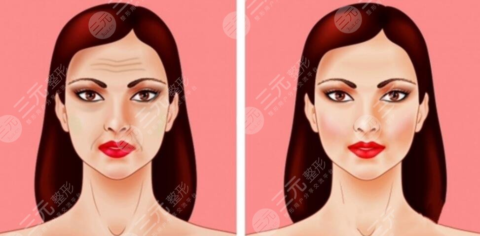 面部下垂提升術(shù)需要注意什么呢?