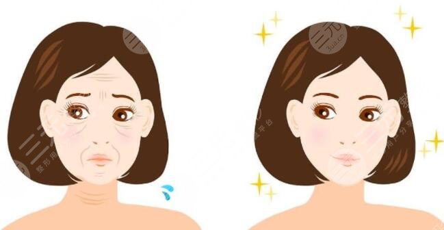 面部下垂提升術(shù)需要注意什么呢?