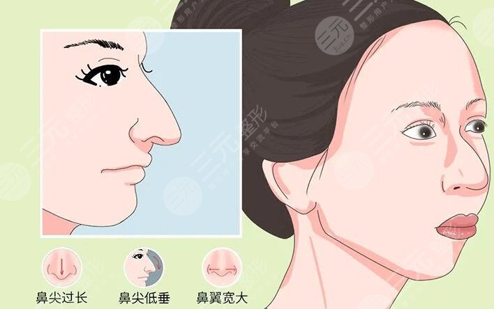 鷹鉤鼻整容整形手術(shù)多少錢2023同步更新！術(shù)前準(zhǔn)備及術(shù)后注意事項牢記于心！