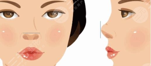 鷹鉤鼻整容整形手術(shù)后需要注意什么?