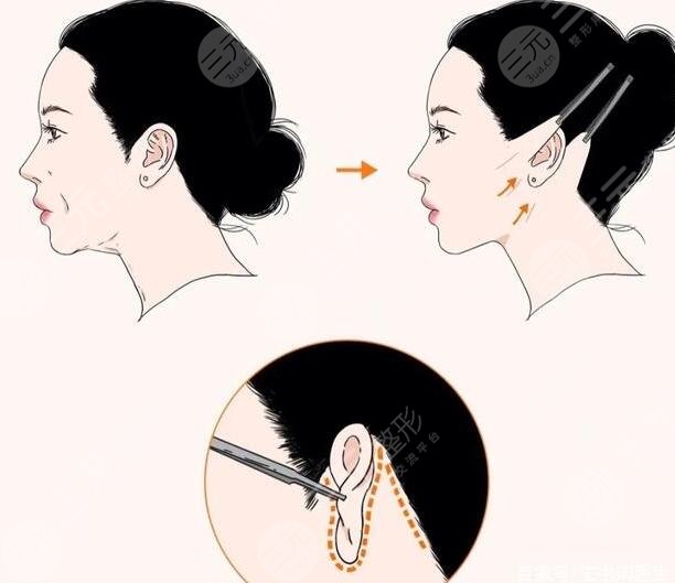 小切口拉皮除皺術(shù)價(jià)格多少？