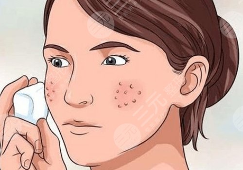臉上有痘印怎么弄才能消除?