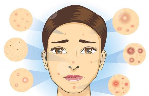 緩解痤瘡后需要注意什么?