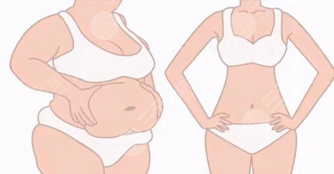 腹部抽脂多少錢一個(gè)部位？