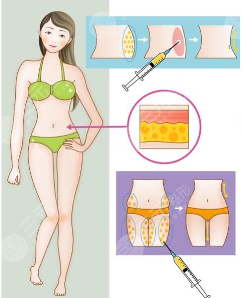 腹部抽血之后要做護(hù)理嗎?