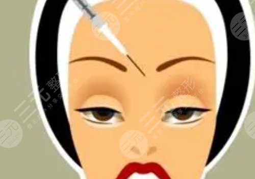 瑞蘭2號(hào)玻尿酸適合打哪里?