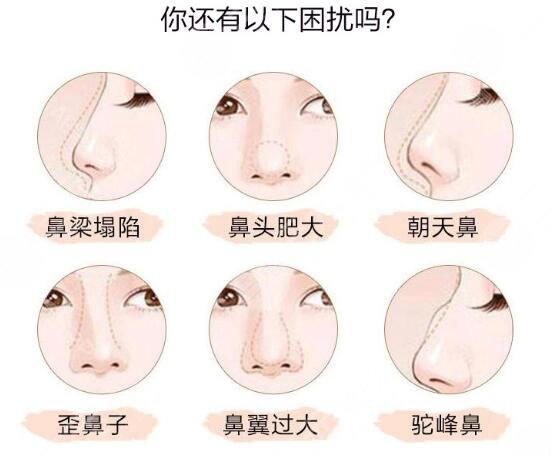 自體軟骨隆鼻好嗎?