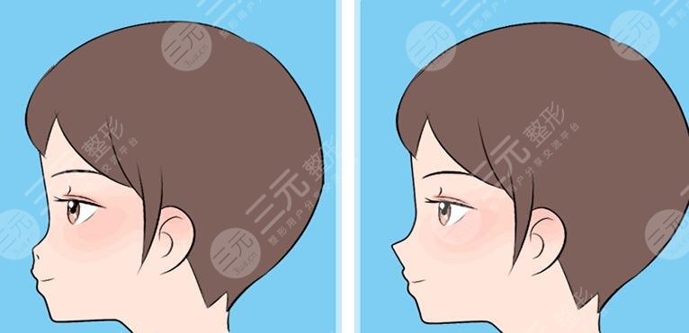 自體軟骨隆鼻注意事項