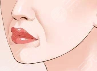 玻尿酸去法令紋需?要多少錢?