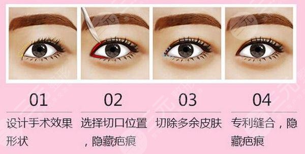 開眼角手術痛嗎?