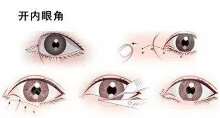 開眼角手術痛嗎?