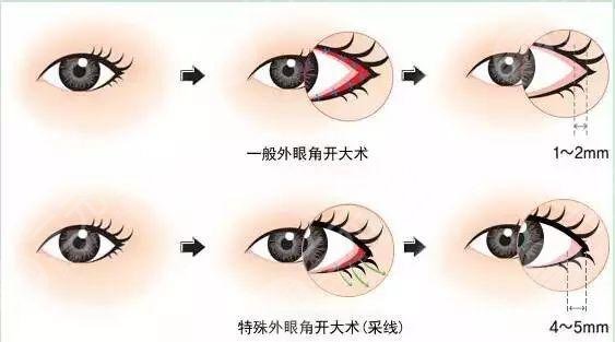 開眼角手術痛嗎?