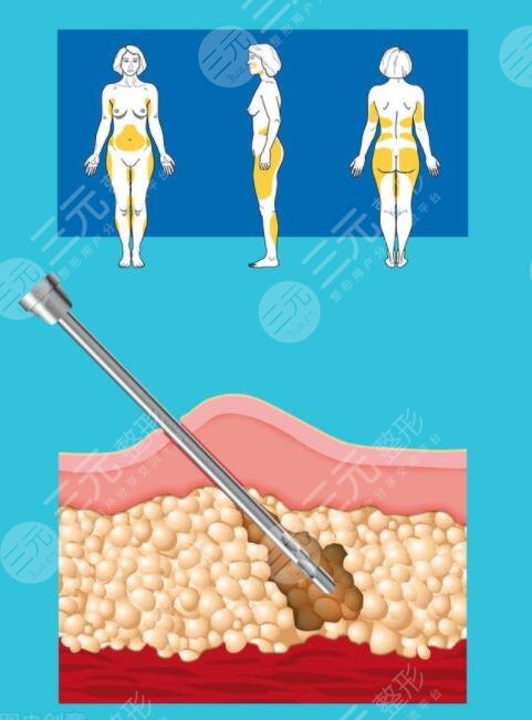 腹部抽脂手術(shù)的主要原理