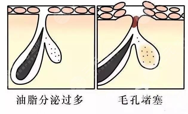 男性毛孔粗大怎么辦?