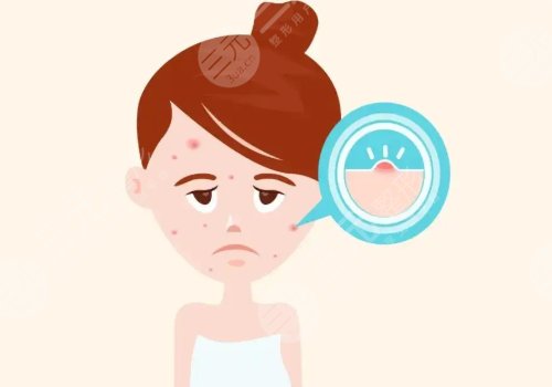 激光祛痘坑痘印有沒有危害?