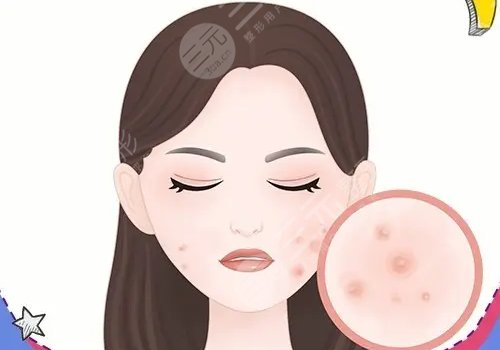 激光祛痘坑痘印有沒有危害?