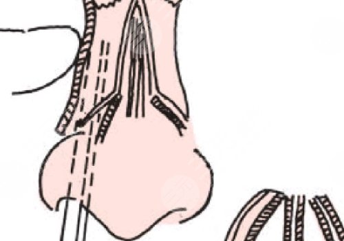 駝峰鼻矯正手術(shù)多少錢?