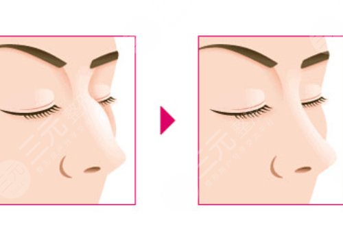 駝峰鼻矯正手術(shù)多少錢?