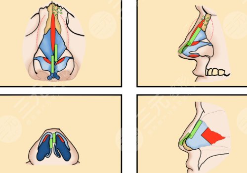駝峰鼻矯正手術(shù)多少錢?