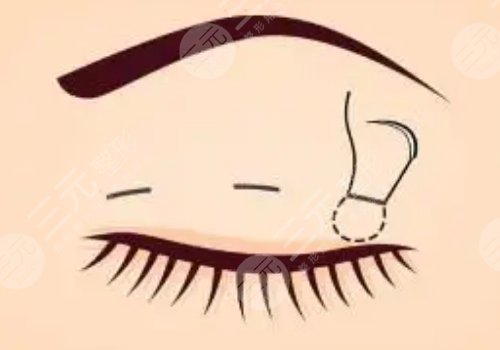 割雙眼皮有什么危害或者后遺癥?