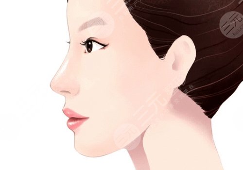 玻尿酸隆鼻會(huì)不會(huì)鼻梁越來(lái)越寬?