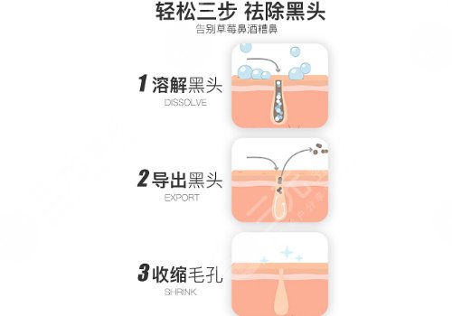 黑頭導(dǎo)出液真的有用嗎?