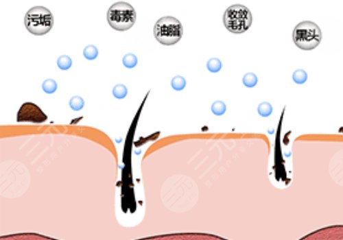 黑頭導(dǎo)出液真的有用嗎?