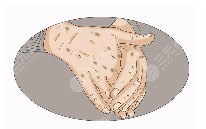 手上老年斑怎么去掉??