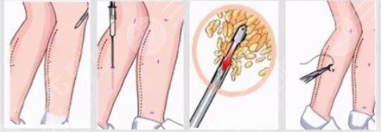 小腿吸脂術(shù)效果好嗎？