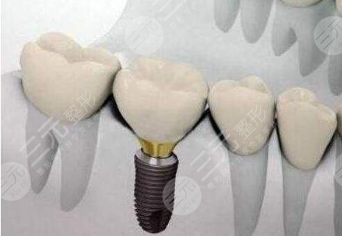 種牙植入種植體后注意什么？