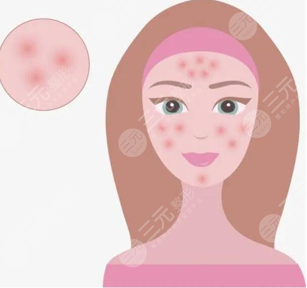 痤瘡的緩解方法有哪些？從生活作息、飲食習(xí)慣、藥物緩解等方面下手！