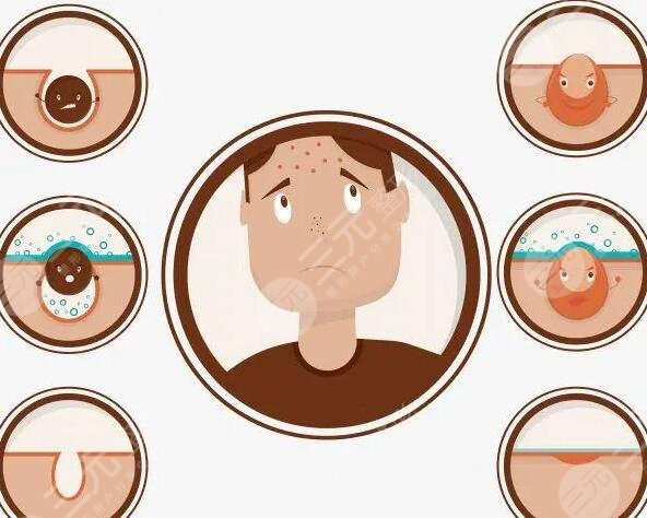 痤瘡的緩解方法有哪些?