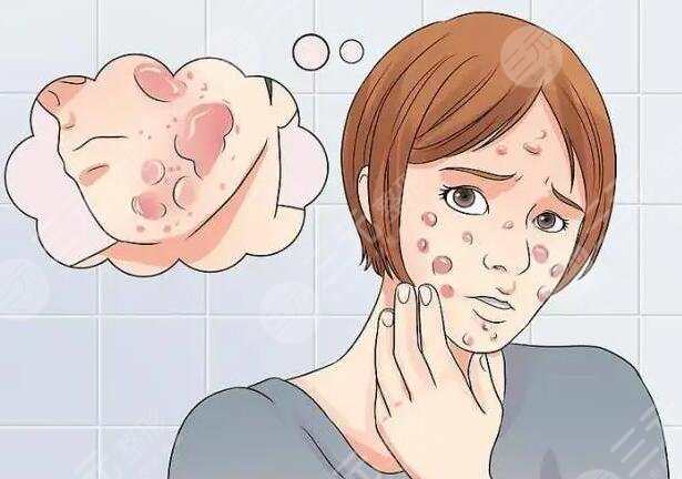 緩解痤瘡的注意事項