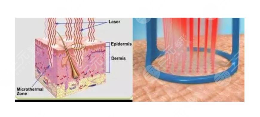 激光祛痘坑痘印有沒有危害?