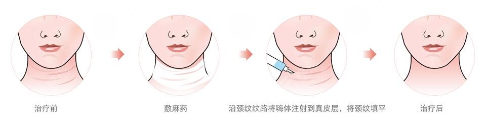 消除雙下巴與頸紋的注意事項(xiàng)